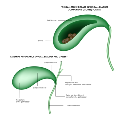 Gallbladder and biliary tract diseases