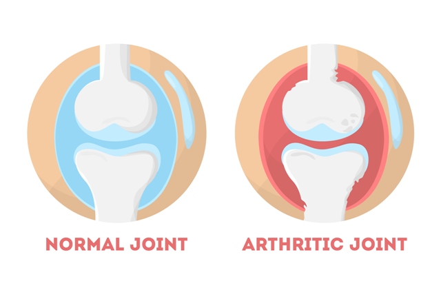 Osteoarthritis