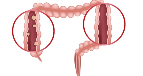 Diverticular disease