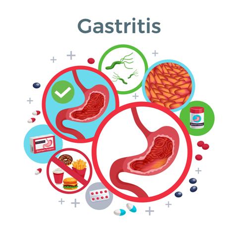 Chronic gastritis