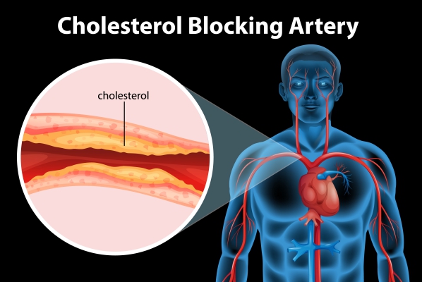 Atherosclerosis