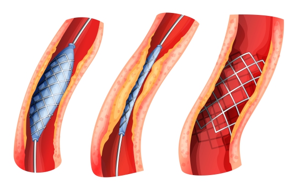 Atherosclerosis