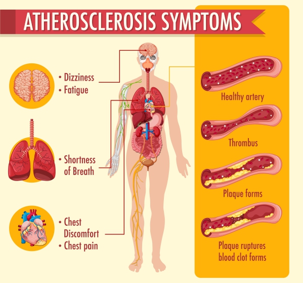 Atherosclerosis