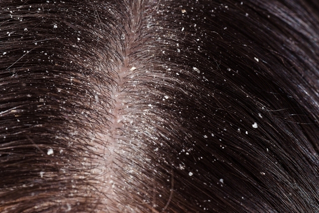 Dandruff