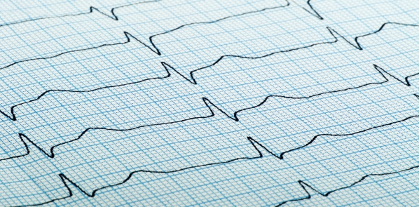 Cardiac arrhythmias