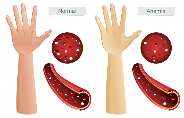 Anemia