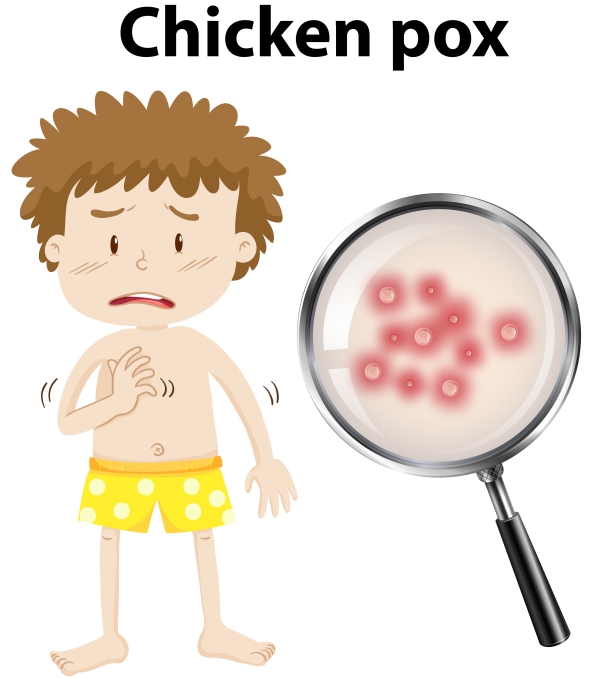 chikenpox