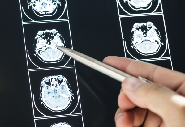 Huntington Disease