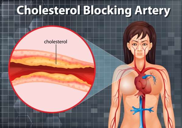 Hyperlipidemia