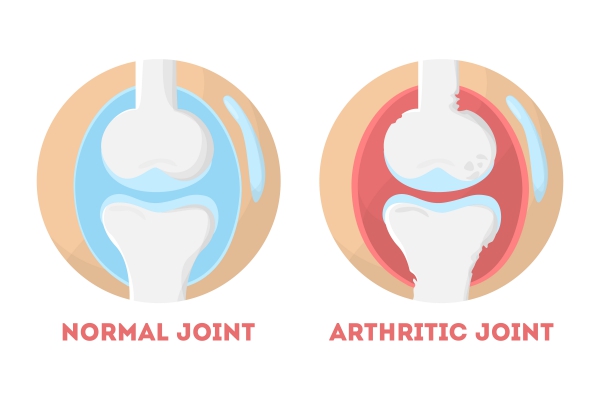 Osteoarthritis