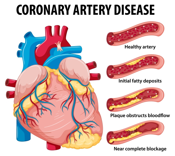 Coronary artery disease