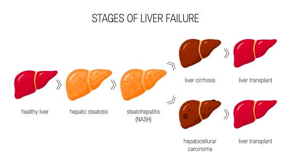 acute-liver-failure