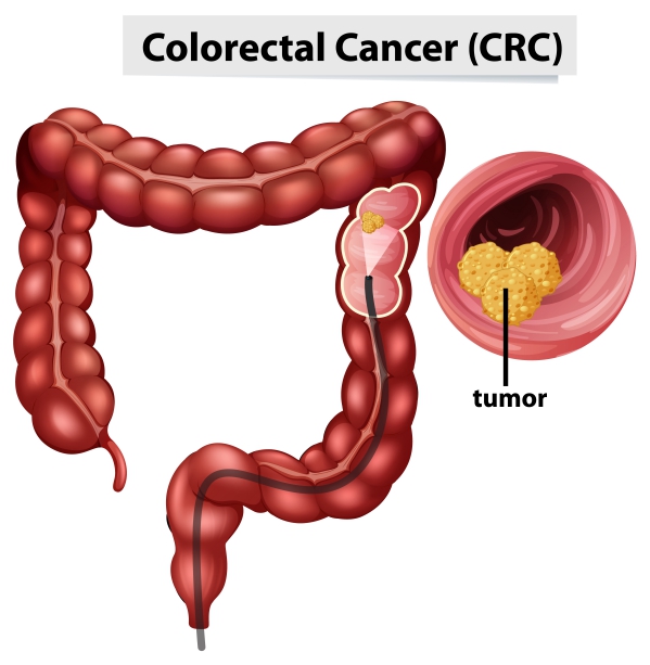 Colorectal cancer