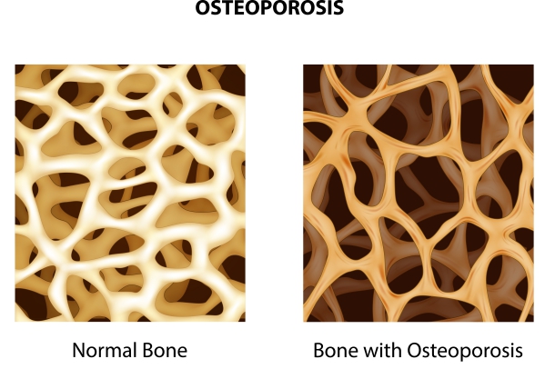 Osteoporosis