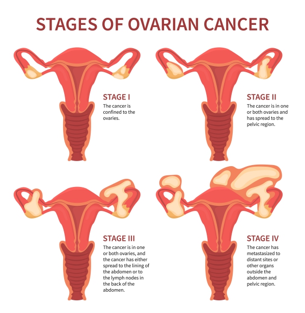 Ovarian cancer