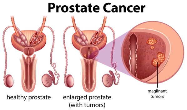 Prostate cancer