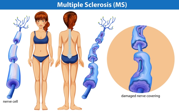 Multiple sclerosis