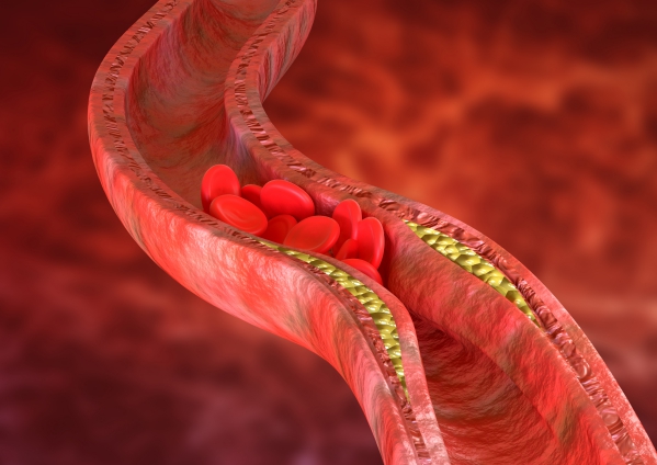 Atherosclerosis